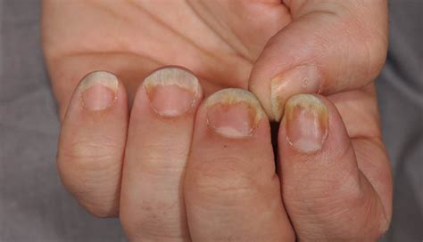 Suffering From Nail Psoriasis Try These 5 Natural Treatment At Home