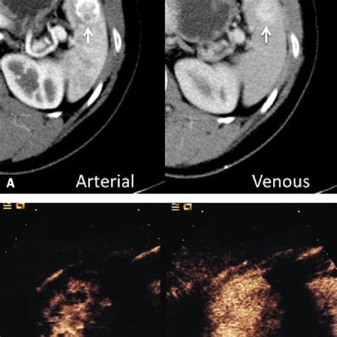 Splenic Hamartoma A Venous Phase Contrast Enhanced Ct Scan Showing A