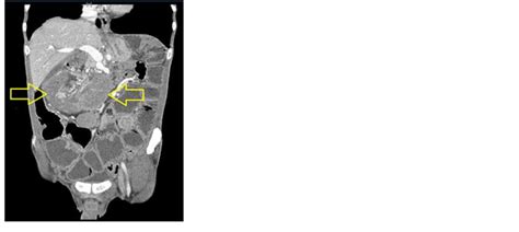 Initial Abdominal Computerized Tomography Scan A Computerized