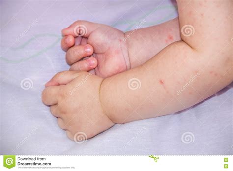These rashes can be caused by food or medication that baby's allergic to, or when baby's skin comes into contact with an irritant, crosby says. Baby With Dermatitis Problem Of Rash. Allergy Suffering ...