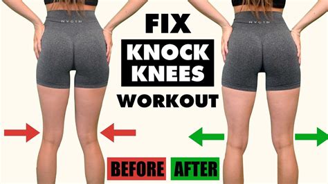 10 Min Knock Knees Home Workout Fix Knock Knees In 10 Minday