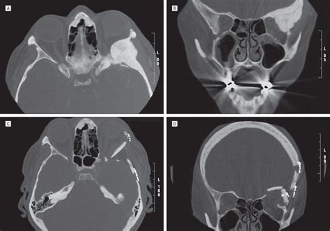 Reconstruction After Resection Of Sphenoid Wing Meningiomas Archives