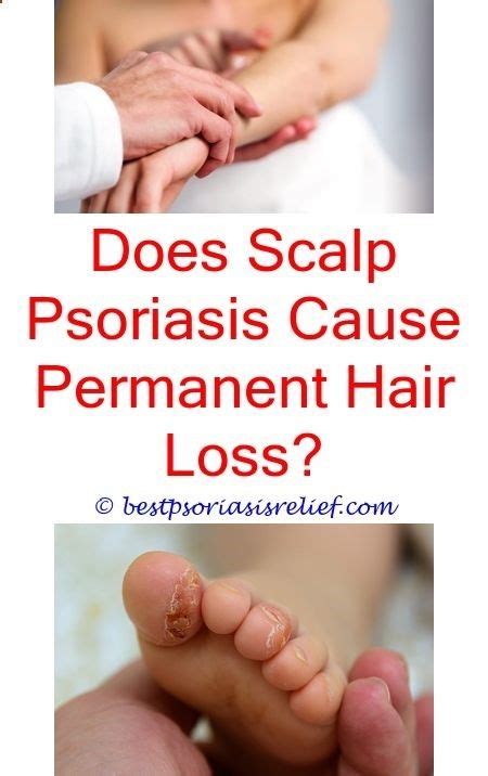 Psoriasiselbow 7 Ways To Treat Psoriasis At Home Psoriasis Of The
