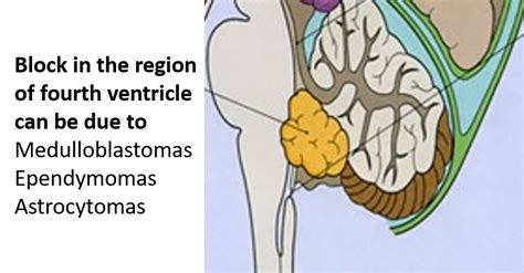 Fourth Ventricle Anatomy Qa