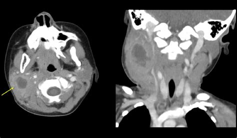 Figure 1 From Acute Sialadenitis In Childhood Ct Findings And Clinical