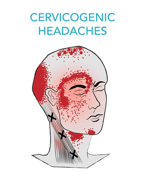 Complete Car Physio Cervicogenic Headache