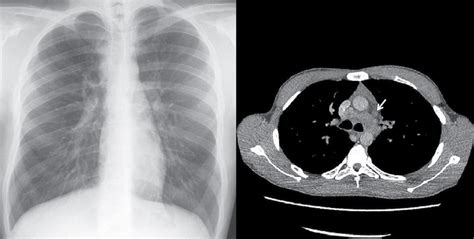 A Chest X Ray Posteroanterior View Showing A Widened Paratracheal