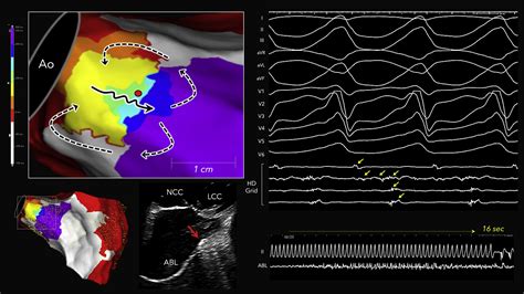 Periaortic Ventricular Tachycardia In Structural Heart Disease