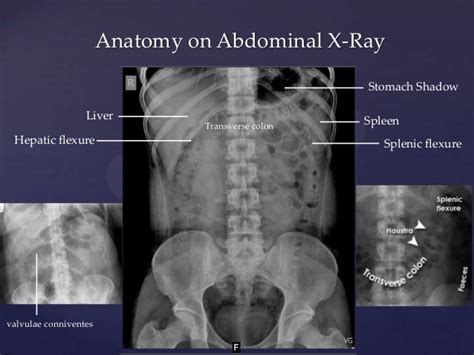 Abdominal X Ray Anatomy