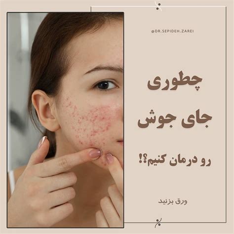 چطوری جای جوش را درمان کنیم؟ درمان جای جوش محصولات مراقبتی آرایشی آوا