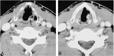 Unilateral Vocal Cord Paralysis A Review Of Ct Findings Mediastinal