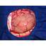 Benign Brain Tumor Stock Photo  Download Image Now IStock