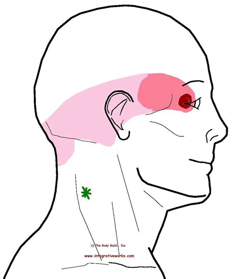 Understanding Trigger Points Neck Ache Headache Eye Ache Trigger