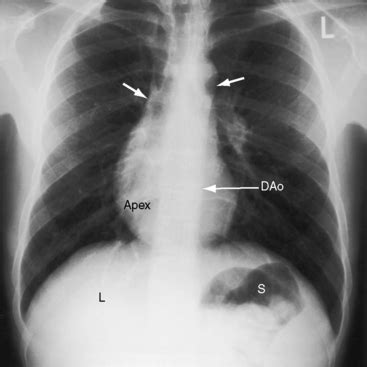 Dextrocardia with situs inversus is a condition that is characterized by abnormal positioning of the heart and other internal organs. Cardiac Malpositions | Thoracic Key