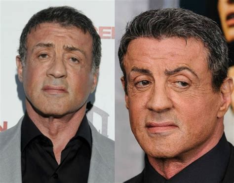 Sylvester Stallone Before And After Plastic Surgery 07 Celebrity