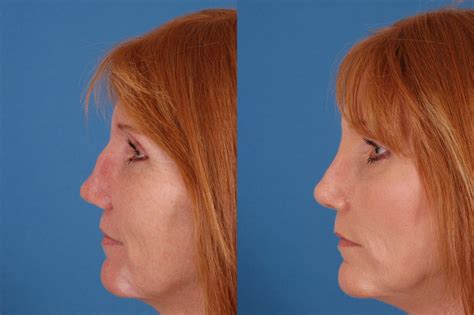 Skin Cancer Reconstruction 4 Dallas Advanced Facial Plastic Surgery