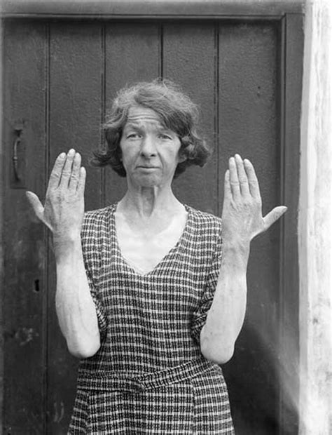 Various causes were discussed over the course of two centuries. File:Female Pellagra sufferer - photo by Dr JC Walsh ...