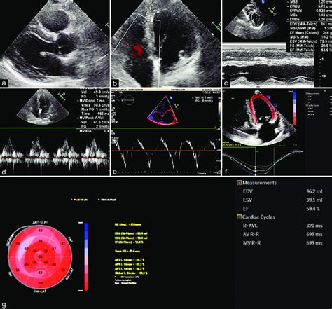 Transthoracic Echocardiography During Follow Up In The Same Patient As