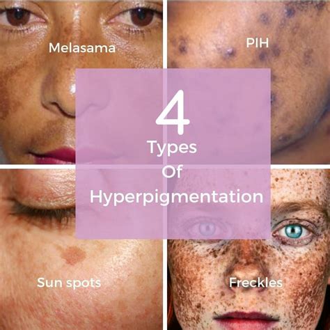 There Are 4 Main Types Of Hyperpigmentation Pih Post Inflammatory
