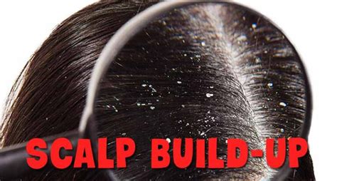 how to clean scalp build up 1