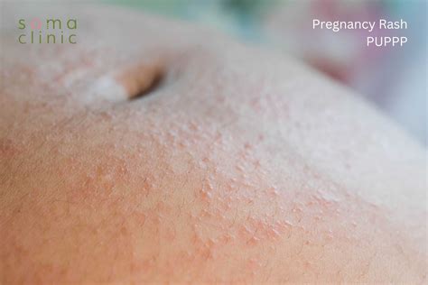Puppp 7 Little Known Ways To Sooth Ypur Pregnancy Rash