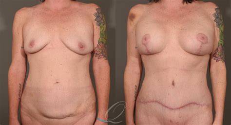 Breast Augmentation With Lift Before After Photos Patient 1001532