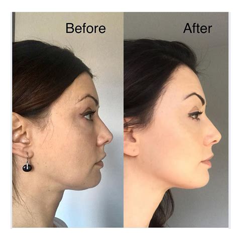 face yoga before and after off 58