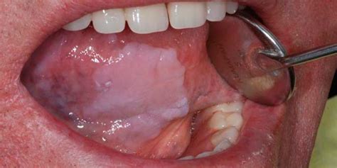 ¿qué Es La Leucoplasia Y Cómo Detectarla Odontologia