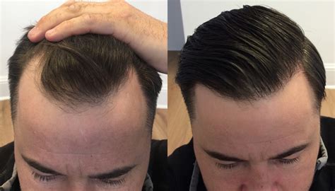 You will see some of these new hairs relatively quickly, but it can take up to six months or longer to see the final, natural results. Hair Transplant: How Long Do They Last? - Down To Earth NW
