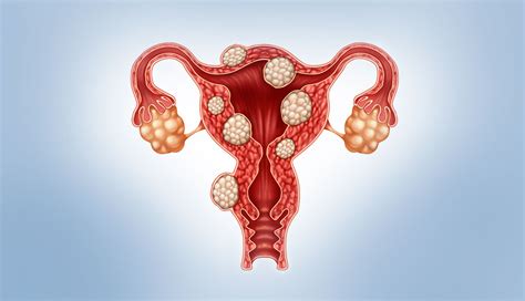 Treatments For Ufe And Uterine Fibroids Unique Interventional