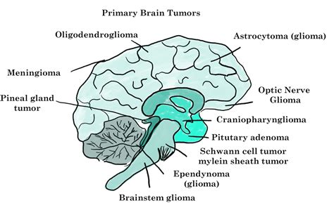 Brain Tumor Cancer Primary Secondary Symptoms Treatment