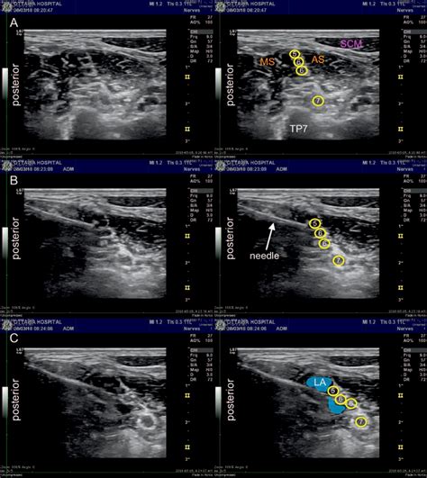Ultrasound Guided Interscalene Block Wfsa Resources