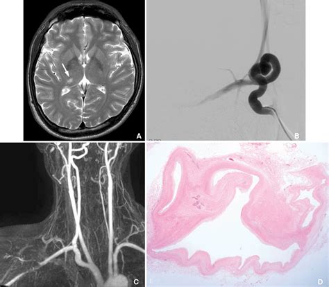 Figure 1 From Cerebral Infarction Caused By A Tortuous Subclavian