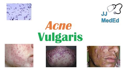 Acne Vulgaris Causes Pathogenesis Influencing Factors Diagnosis