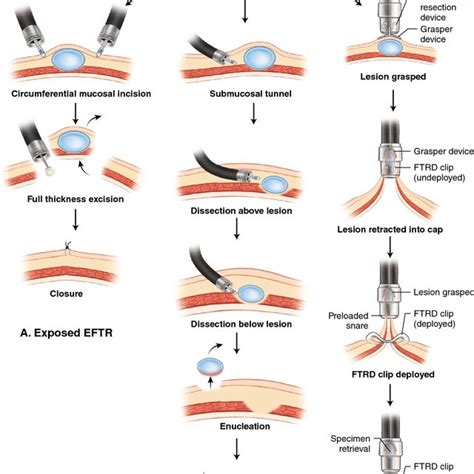 Colorectal Endoscopic Submucosal Dissection A A 55 Mm Laterally