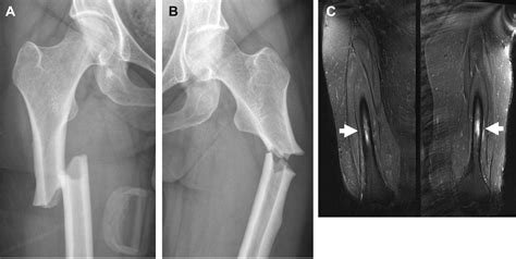 Atypical Femoral Fractures In Patients Taking Longterm Alendronate