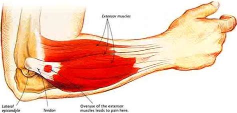 Related online courses on physioplus. Physiotherapy North Sydney: Is this Tennis Elbow?