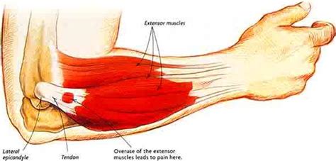 Figure 13 normal anatomy of the elbow at named triceps muscle has three heads at its proximal. Physiotherapy North Sydney: Is this Tennis Elbow?
