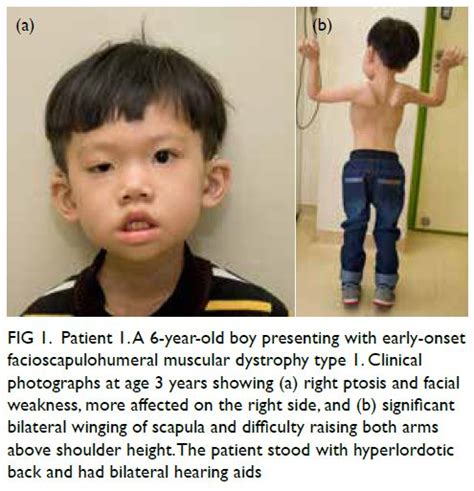 Infantile To Late Adulthood Onset Facioscapulohumeral Dystrophy Type 1