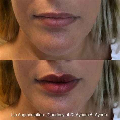Fat Transfer Lip Augmentation Before And After Lips Makeupview