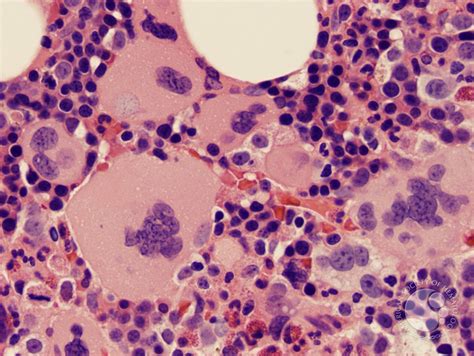 Myelofibrosis And Megakaryocyte Clustering 4