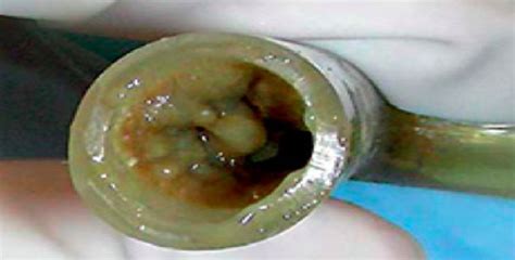 Formation Of Mucus Plug Within A Stent The Inability To Clear