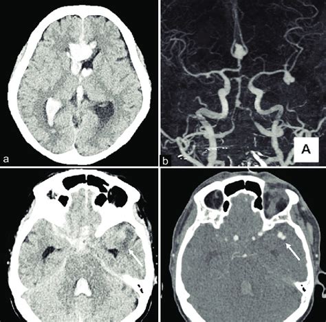 Initial Computed Tomography Ct Image Showing Thick Subarachnoid