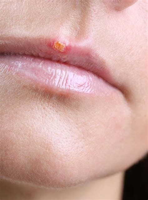 How Can I Treat A Cold Sore During Pregnancy With Pictures