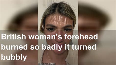 British Womans Forehead Burned So Badly It Turned Bubbly Youtube