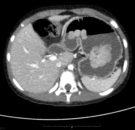 Peutz Jeghers Syndrome Radiology Reference Article