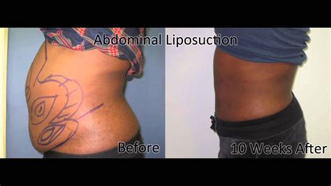 Learn More About Tumescent Liposuction Youtube