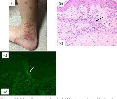 Figure 1 From Endothelial Damage Dominant Nephritis Related To Iga