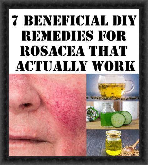 7 Beneficial Diy Remedies For Rosacea That Actually Work Rosacea Diy