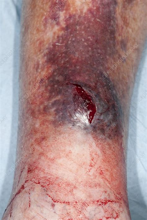 Laceration on leg - Stock Image - C019/9650 - Science Photo Library